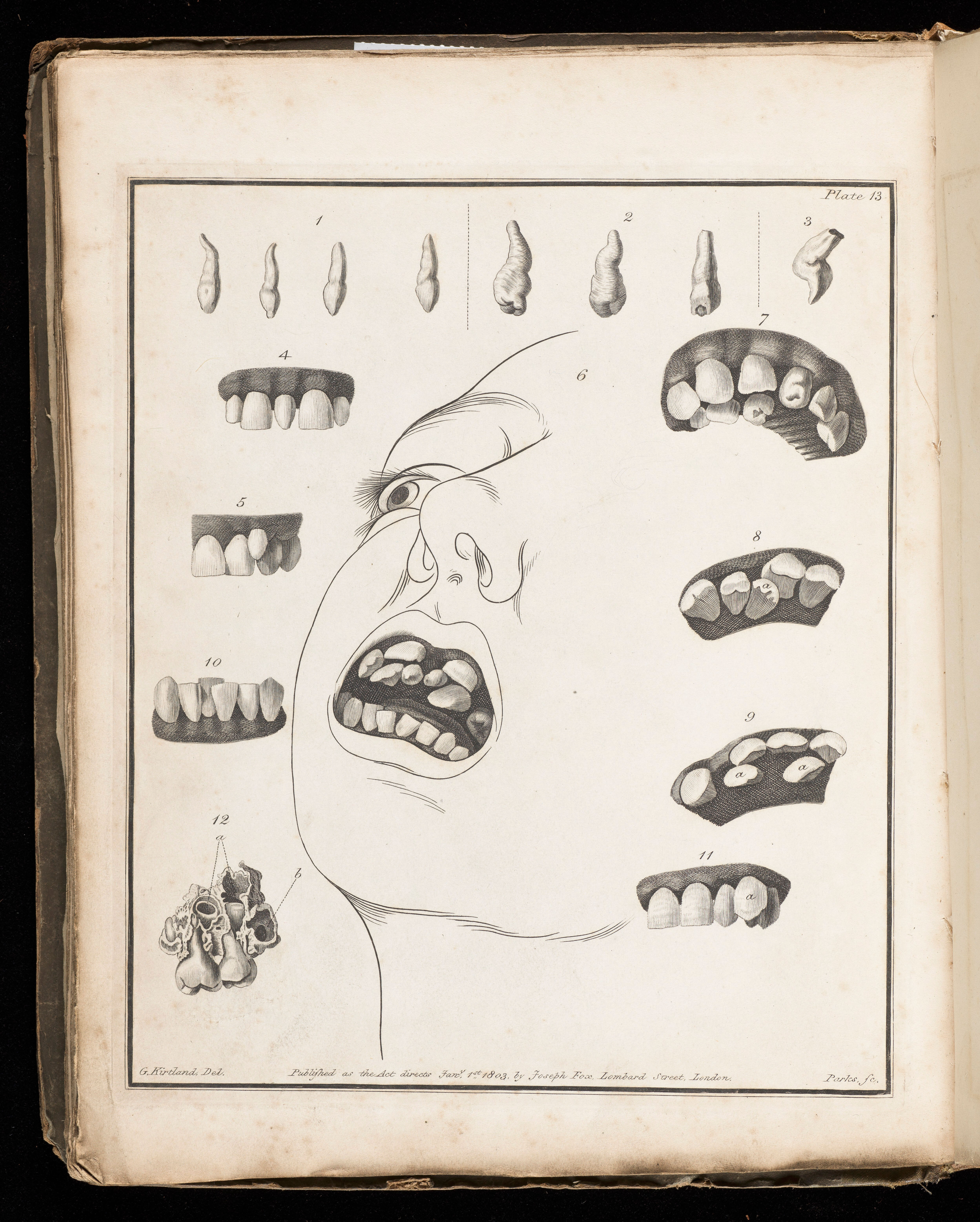 A case of “supernumerary” teeth from The natural history and diseases, of the human teeth: in two parts illustrated with twenty-three copper-plates by Joseph Fox, 1814.