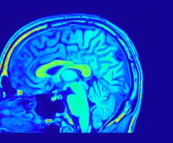 A photo of a brain scan showing the profile view of the brain in a person's skull. The scan is made up of various shades of blue giving the structure of the brain and its surroundings. 